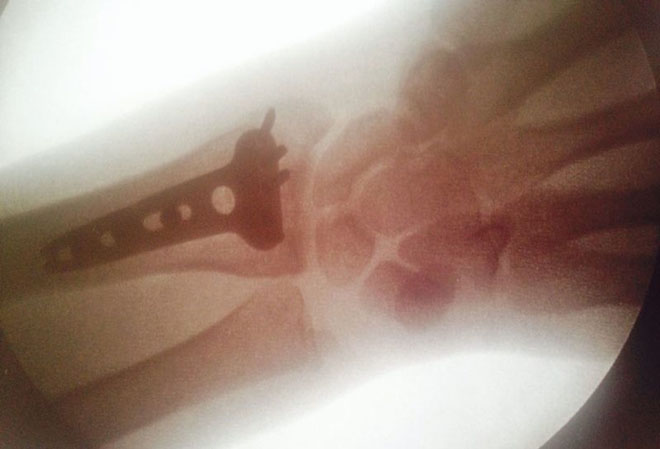 Röntgenbild der fixierten Speiche nach der OP.