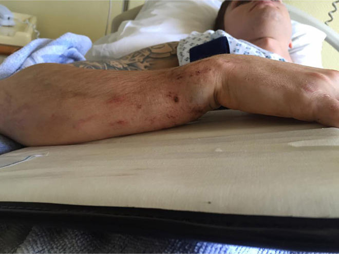 Jake Nicholls mit gebrochenem Arm in Krankenhaus.